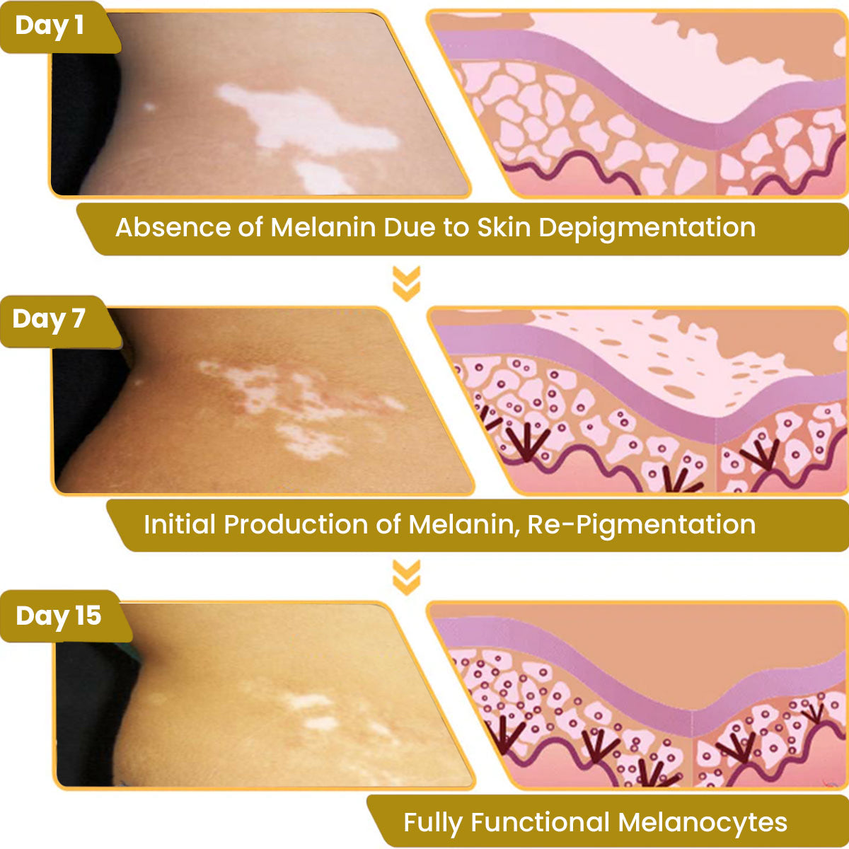 FLYCARE™ Vitiligo Bee Venom Care Skin Cream