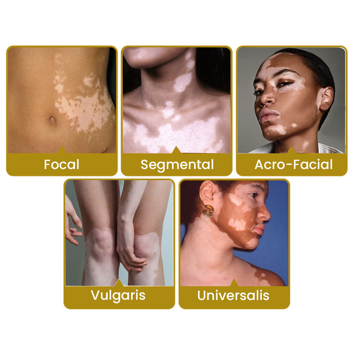 FLYCARE™ Vitiligo Bee Venom Care Skin Cream