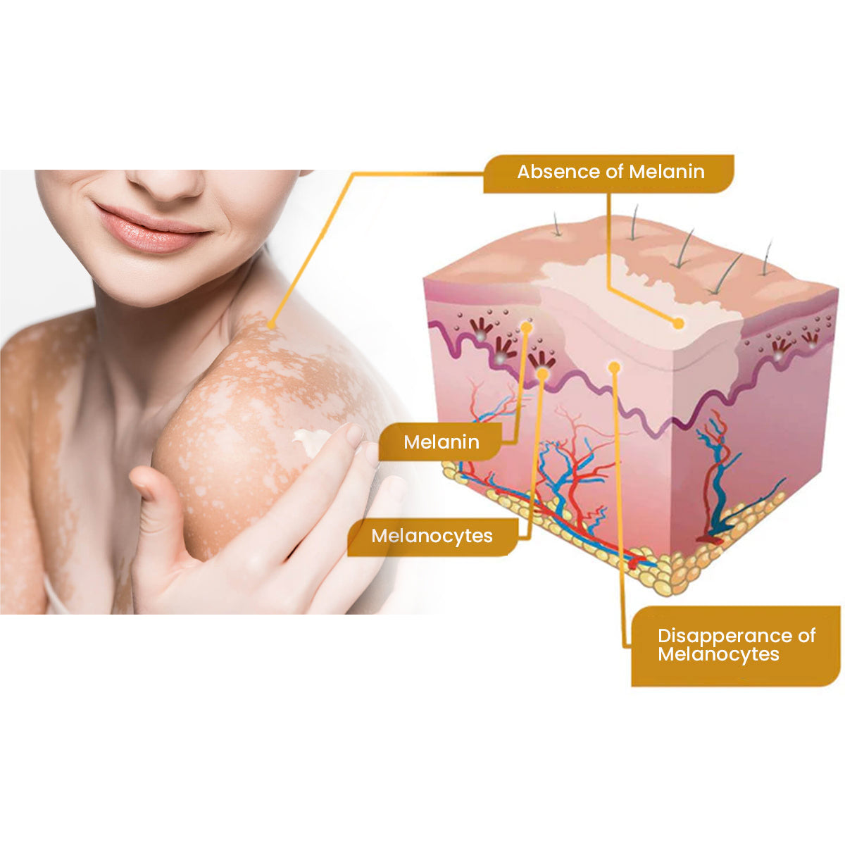 FLYCARE™ Vitiligo Bee Venom Care Skin Cream