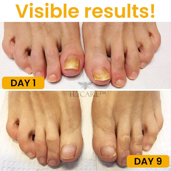 FLYCARE™ Bee Venom Nail Fungus Treatment Soak ⏰ SALE ENDS IN 10 MINUTES ⏰