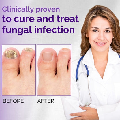 FLYCARE™ Nail Fungal Essence