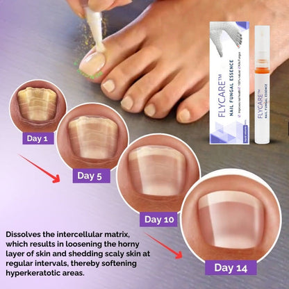 FLYCARE™ Nail Fungal Essence