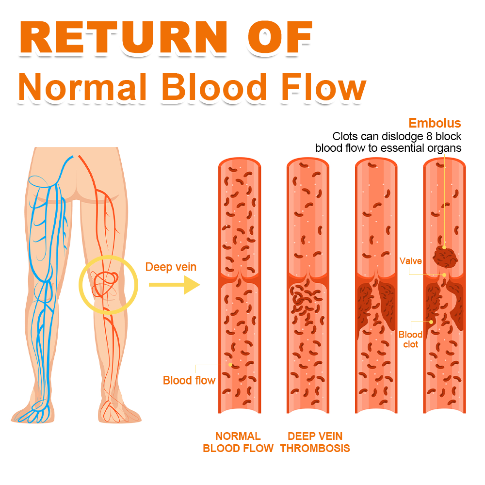 FLYCARE™ Arthritis and Varicose Vein Treatment Cream