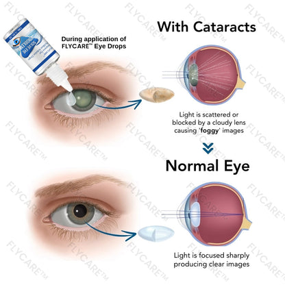 FLYCARE™ Myopia Reversal Eye Drops