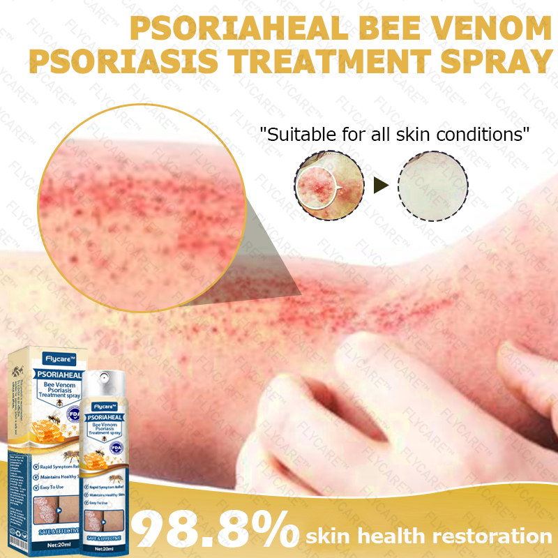 FLYCARE™ PsoriaHeal Bee Venom Psoriasis Treatment Spray 🔥 Last Day Sale Off 80%🔥