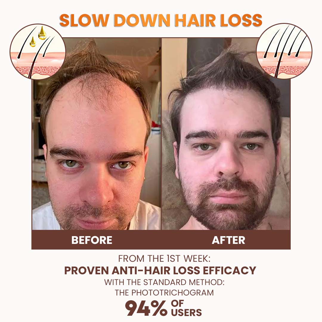 Stovis™ Premium Biotin Hair&Beard Booster ⏰ SALE ENDS IN 10 MINUTES ⏰