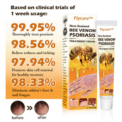 New Zealand Bee Venom Psoriasis Treatment Cream (Suitable for all skin conditions)