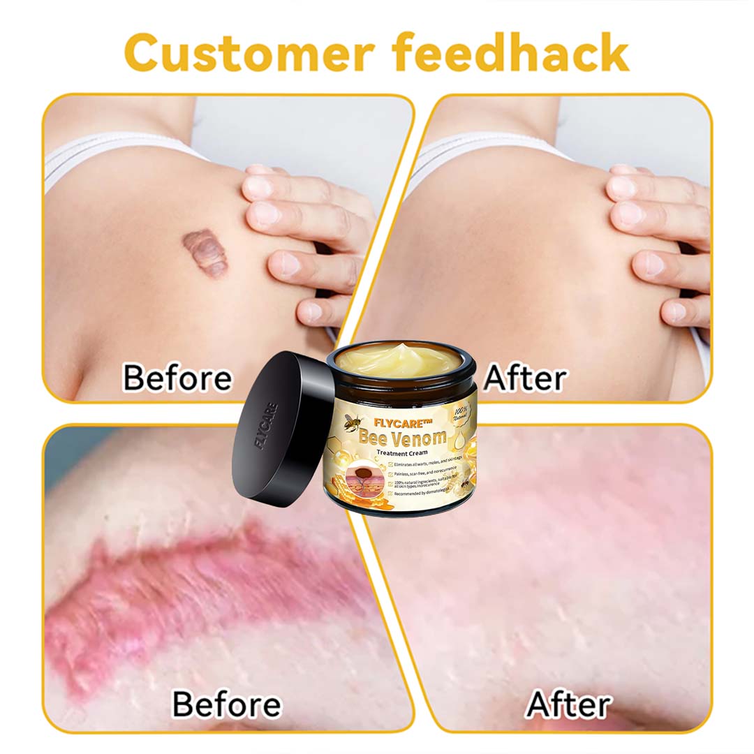 FLYCARE™ Advanced Bee Venom Skin Treatment Cream（𝐴𝐴𝐷 𝑅𝑒𝑐𝑜𝑚𝑚𝑒𝑛𝑑𝑒𝑑）